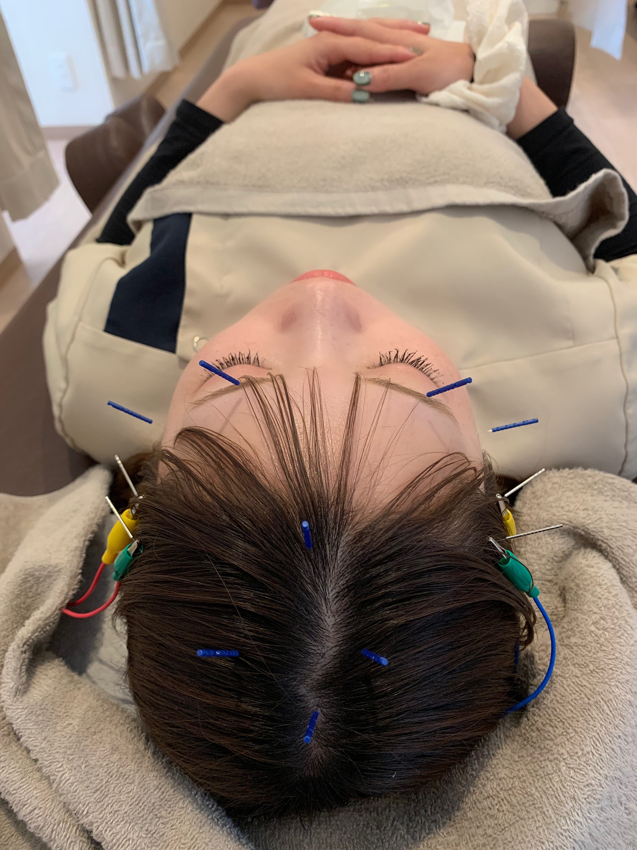 気圧の変化で起こる偏頭痛|心輝style整骨院